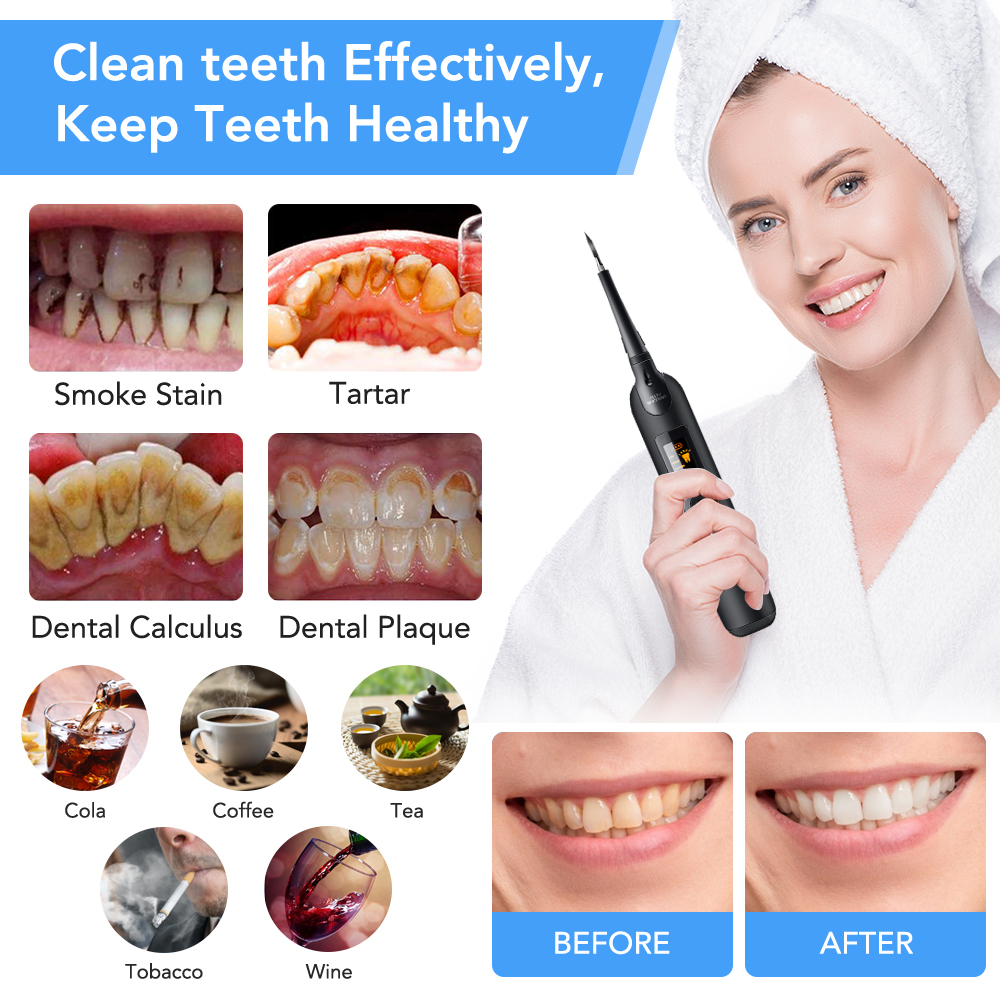 Teeth Tartar Remover Electric  - đánh giá và giá Teeth Whitening Home Kit