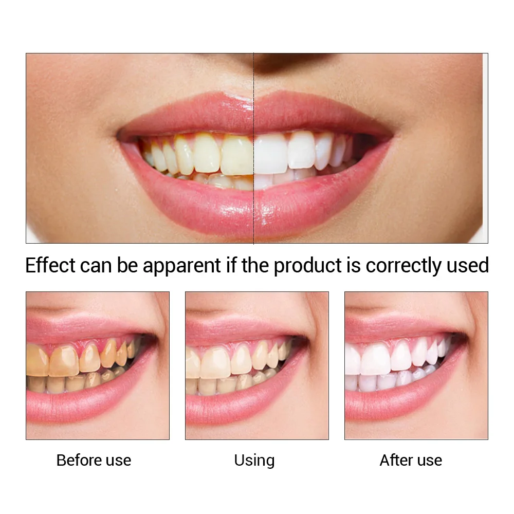 FTEENPLY Teeth Whitening Essen - đánh giá và giá Teeth Whitening Bleach
