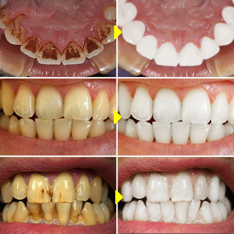 V34 Teeth Whitening Mousse Too - đánh giá và giá Teeth Whitening Bleach