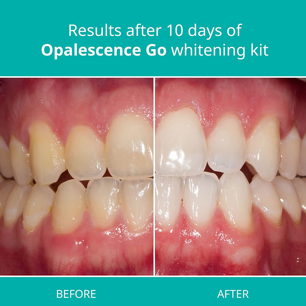 Opalescence Go Teeth Whitening - đánh giá và giá Teeth Whitening Home Kit